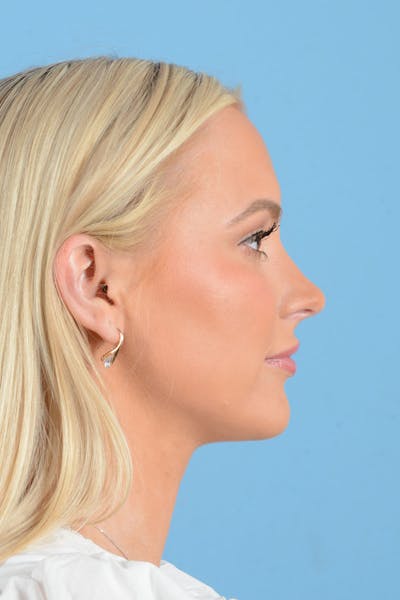 Liposuction Before & After Gallery - Patient 381753 - Image 8