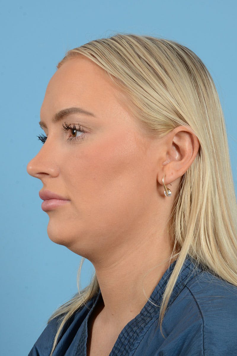 Liposuction Before & After Gallery - Patient 381753 - Image 3