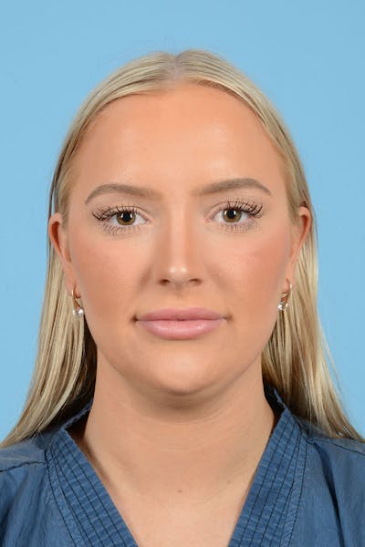 Liposuction Before & After Gallery - Patient 381753 - Image 1