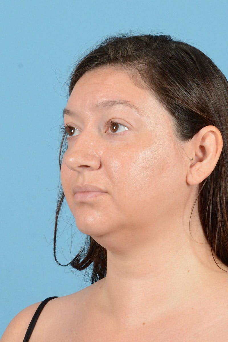 Liposuction Before & After Gallery - Patient 304044 - Image 3