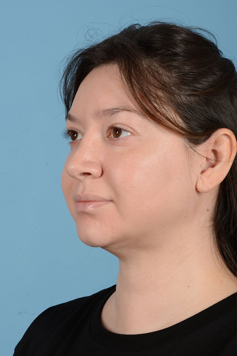 Liposuction Before & After Gallery - Patient 304044 - Image 4