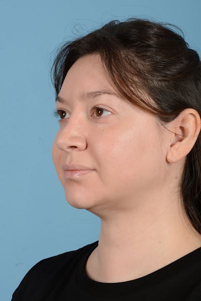 Liposuction Before & After Gallery - Patient 304044 - Image 4