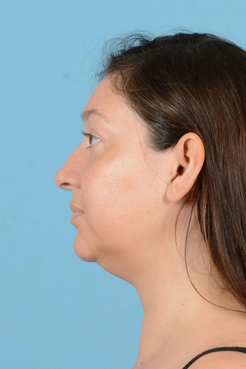 Liposuction Before & After Gallery - Patient 304044 - Image 5