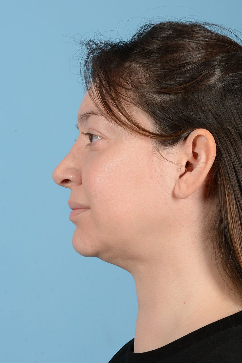 Liposuction Before & After Gallery - Patient 304044 - Image 6