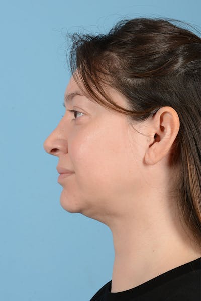Liposuction Before & After Gallery - Patient 304044 - Image 6
