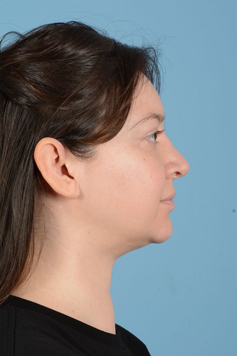 Liposuction Before & After Gallery - Patient 304044 - Image 8