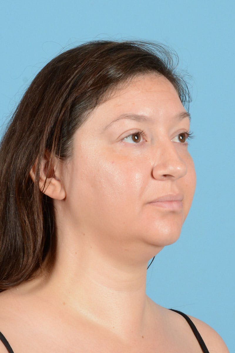 Liposuction Before & After Gallery - Patient 304044 - Image 9