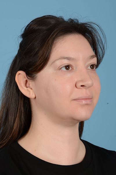 Liposuction Before & After Gallery - Patient 304044 - Image 10