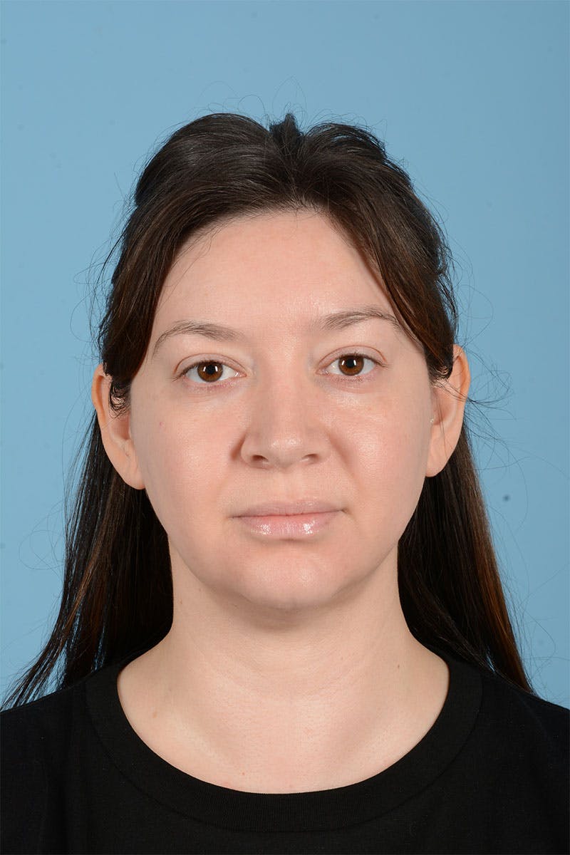 Liposuction Before & After Gallery - Patient 304044 - Image 2
