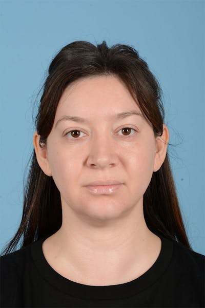 Liposuction Before & After Gallery - Patient 304044 - Image 2
