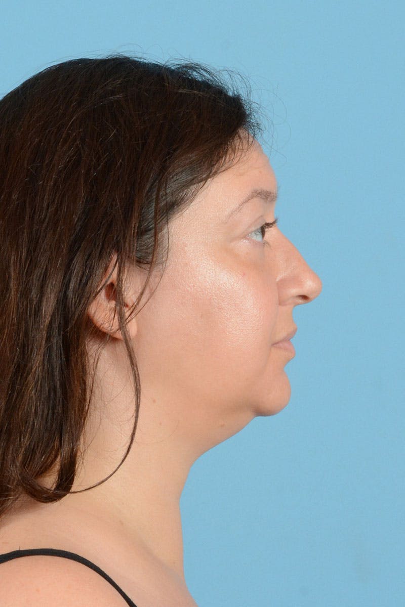 Liposuction Before & After Gallery - Patient 304044 - Image 7