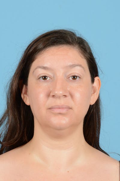 Liposuction Before & After Gallery - Patient 304044 - Image 1