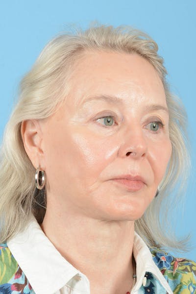 Facial Augmentation Before & After Gallery - Patient 337899 - Image 12