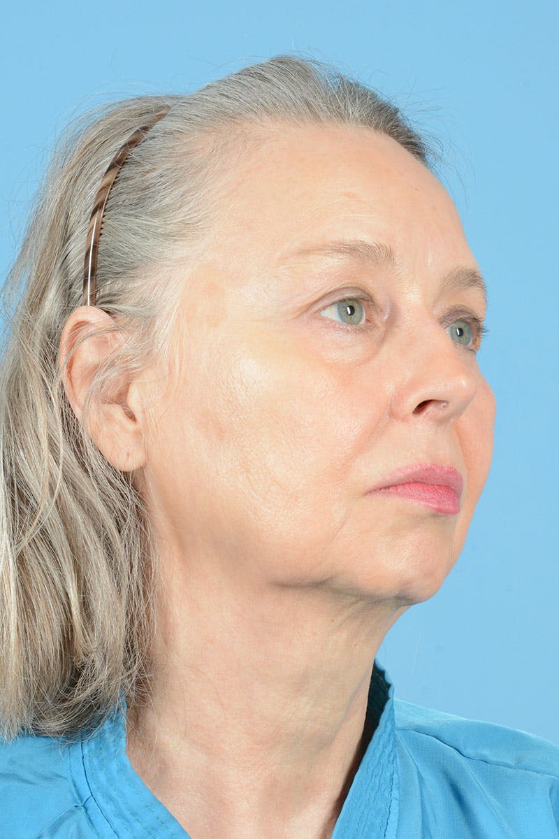 Facial Augmentation Before & After Gallery - Patient 337899 - Image 11