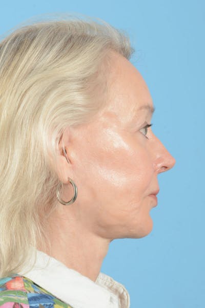 Facial Augmentation Before & After Gallery - Patient 337899 - Image 10