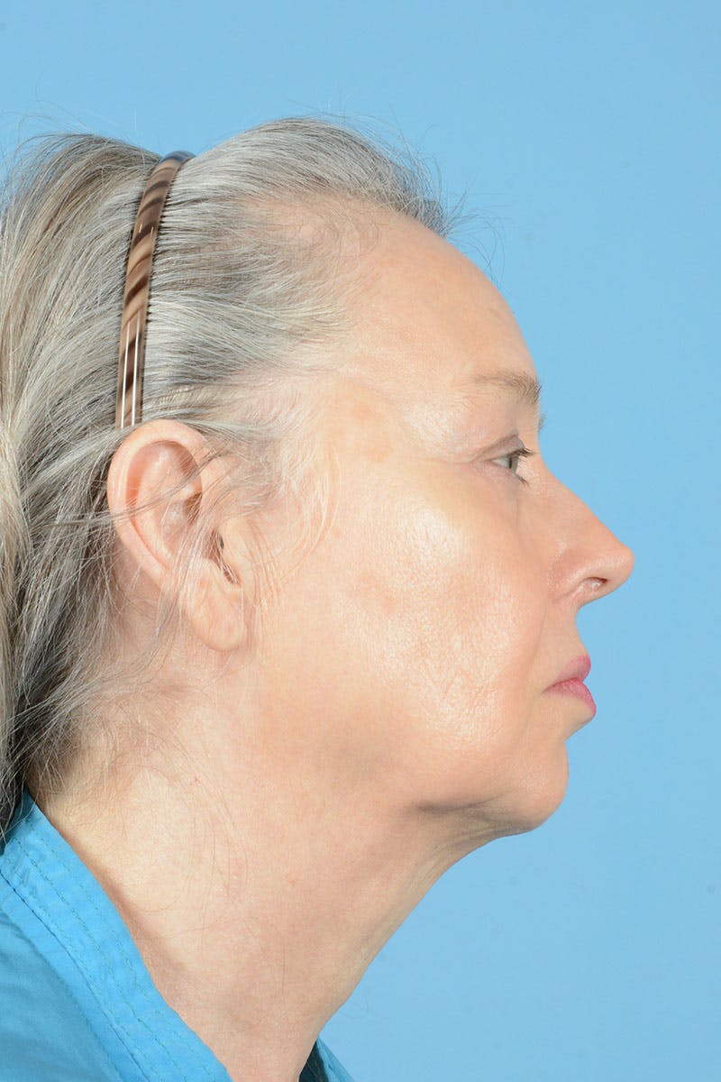 Facial Augmentation Before & After Gallery - Patient 337899 - Image 9