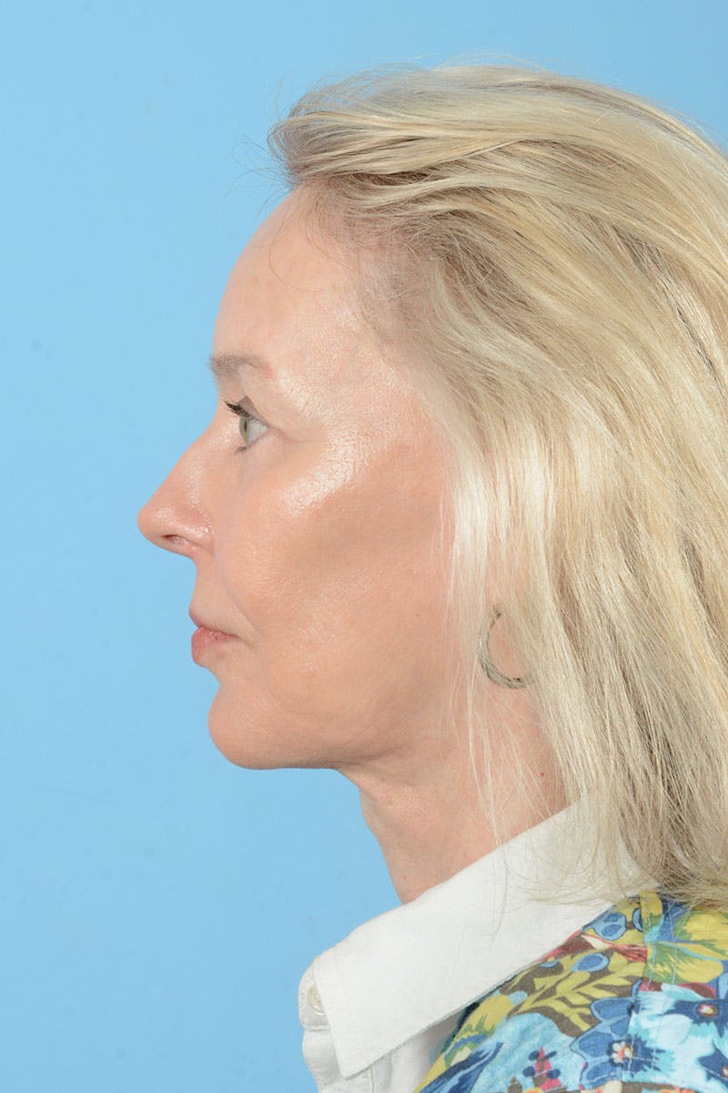 Facial Augmentation Before & After Gallery - Patient 337899 - Image 8