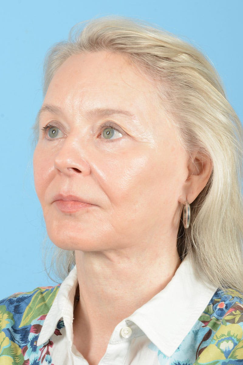 Facial Augmentation Before & After Gallery - Patient 337899 - Image 6