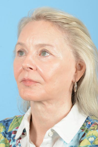 Facial Augmentation Before & After Gallery - Patient 337899 - Image 6