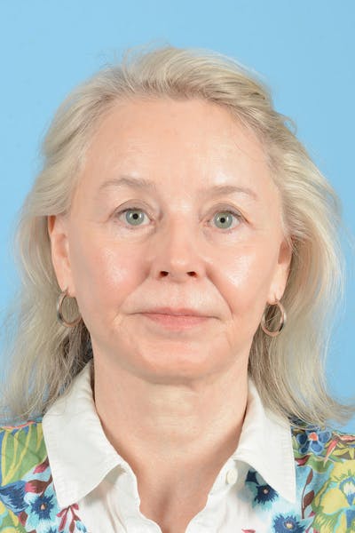Facelift Before & After Gallery - Patient 223106 - Image 2