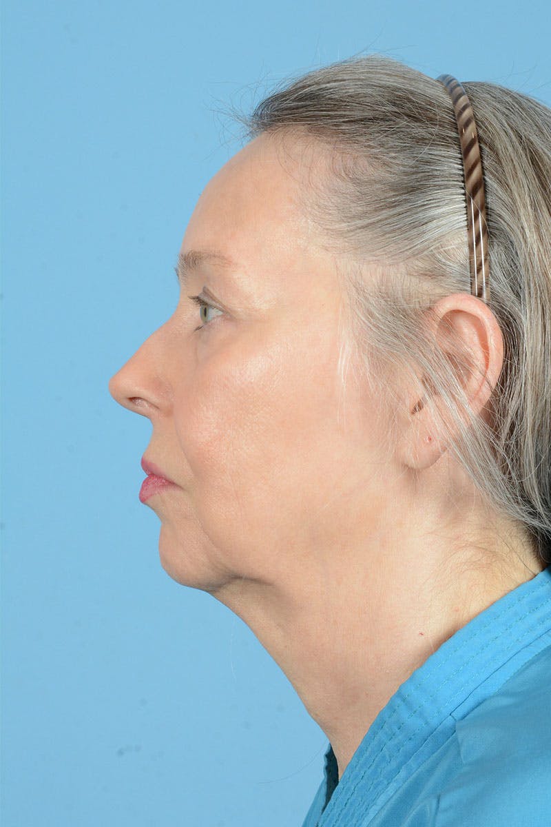 Facial Augmentation Before & After Gallery - Patient 337899 - Image 7