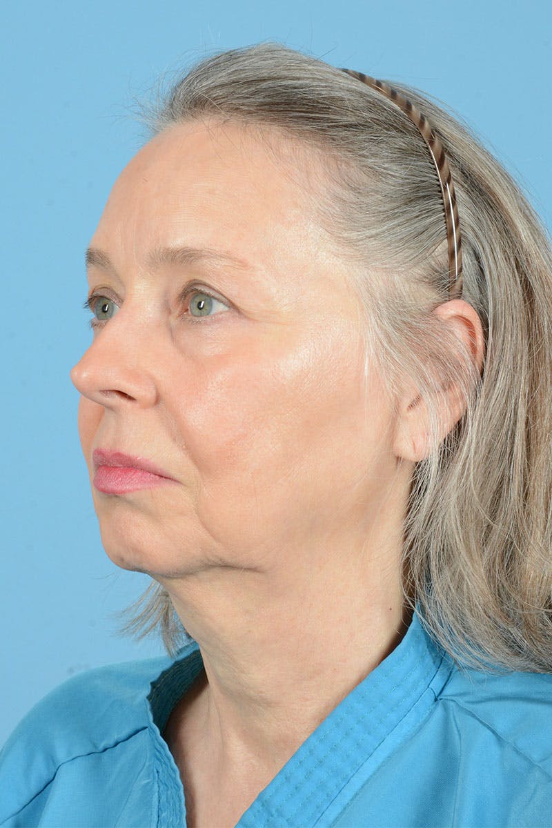 Facial Augmentation Before & After Gallery - Patient 337899 - Image 5