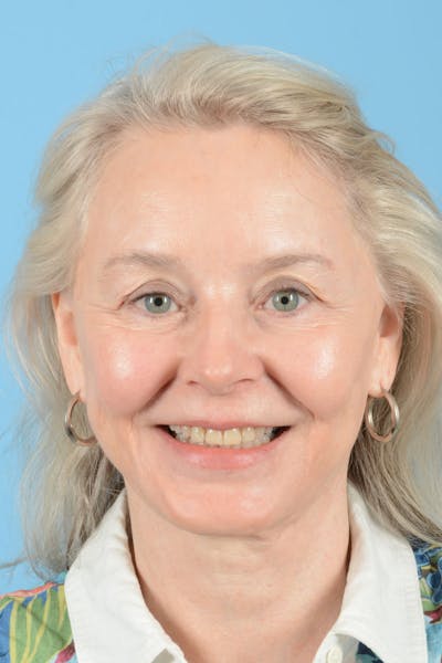 Facial Augmentation Before & After Gallery - Patient 337899 - Image 4