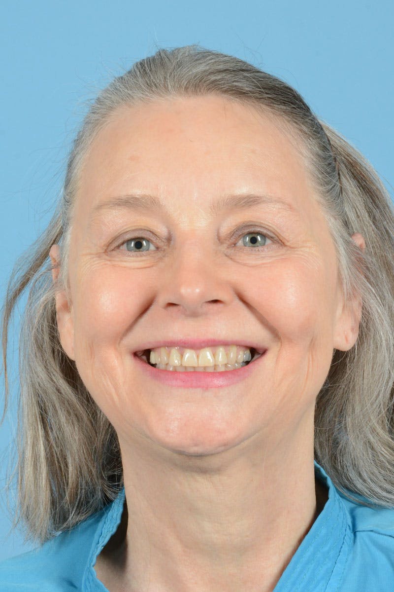 Facial Augmentation Before & After Gallery - Patient 337899 - Image 3