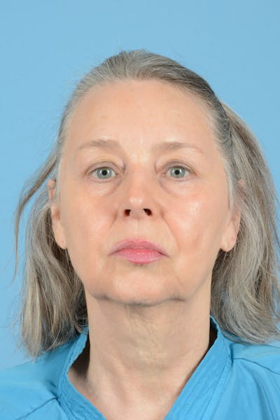 Facelift Before & After Gallery - Patient 223106 - Image 1