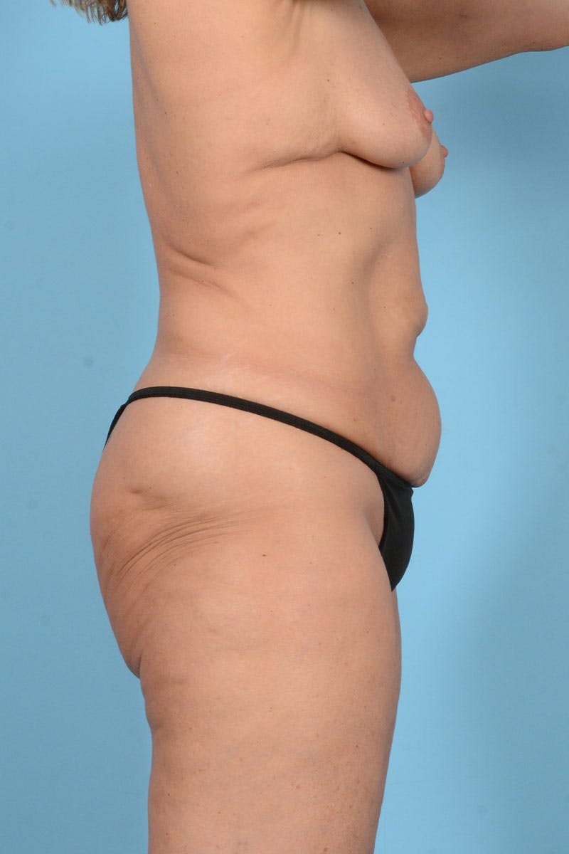 Mommy Makeover Before & After Gallery - Patient 174097 - Image 13