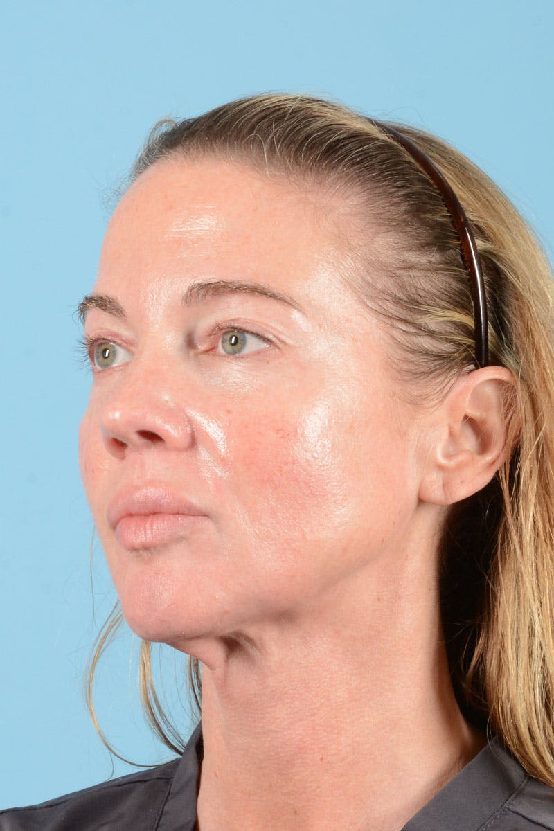Facial Augmentation Before & After Gallery - Patient 238488 - Image 4