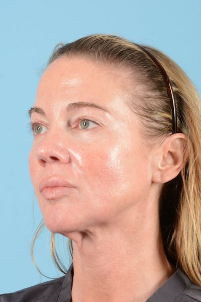 Facial Augmentation Before & After Gallery - Patient 238488 - Image 4