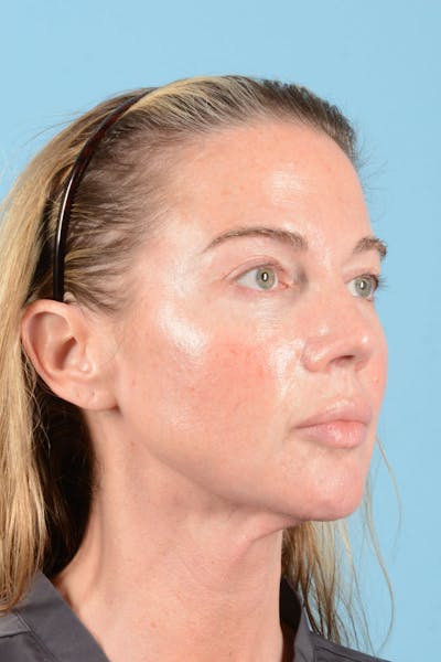 Facial Augmentation Before & After Gallery - Patient 238488 - Image 10