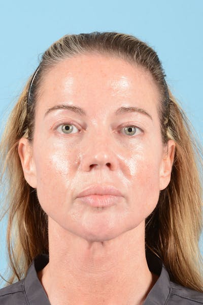 Facial Augmentation Before & After Gallery - Patient 238488 - Image 2
