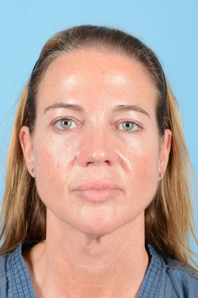 Facial Augmentation Before & After Gallery - Patient 238488 - Image 1