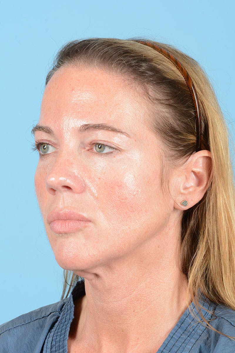 Facial Augmentation Before & After Gallery - Patient 238488 - Image 3