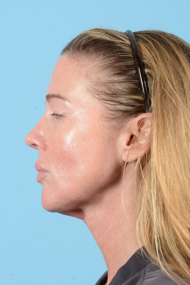 Facial Augmentation Before & After Gallery - Patient 238488 - Image 6