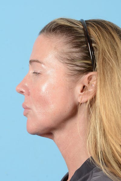 Facial Augmentation Before & After Gallery - Patient 238488 - Image 6