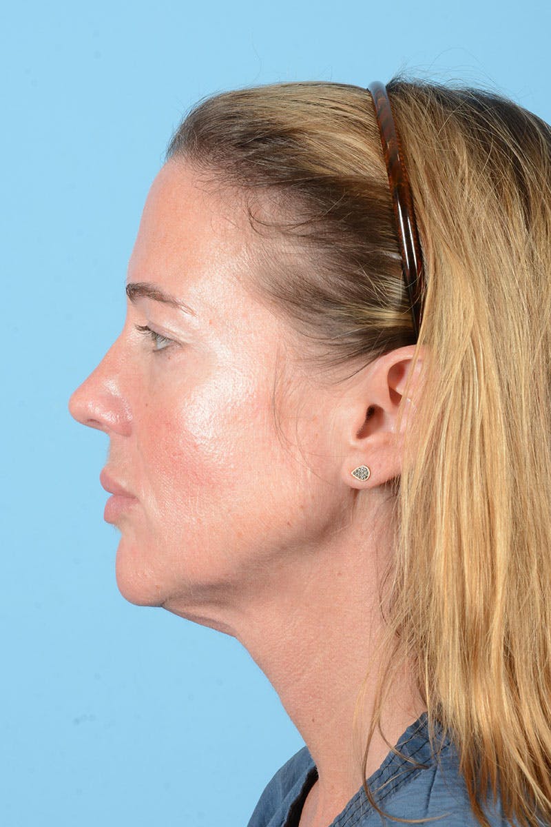 Facial Augmentation Before & After Gallery - Patient 238488 - Image 5