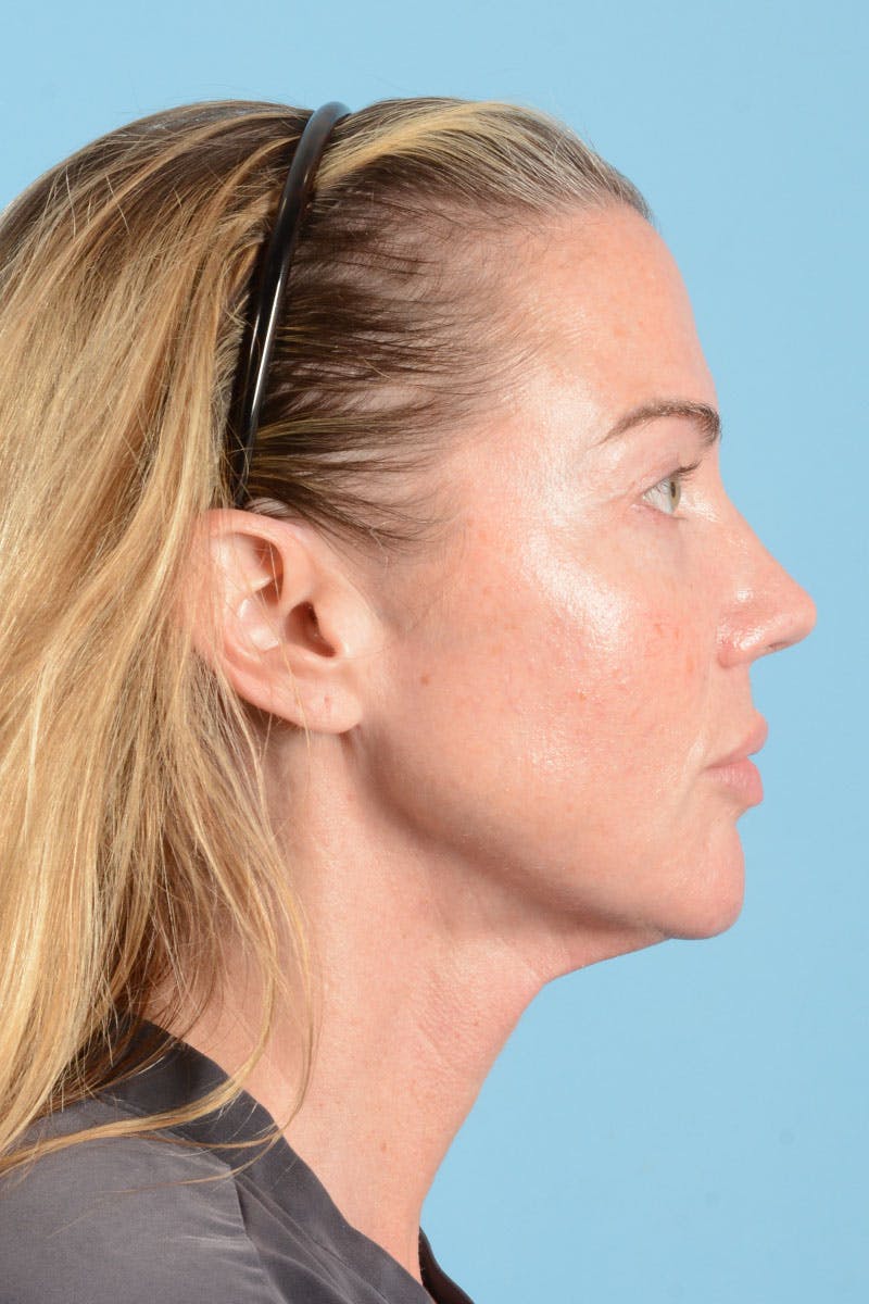 Facial Augmentation Before & After Gallery - Patient 238488 - Image 8