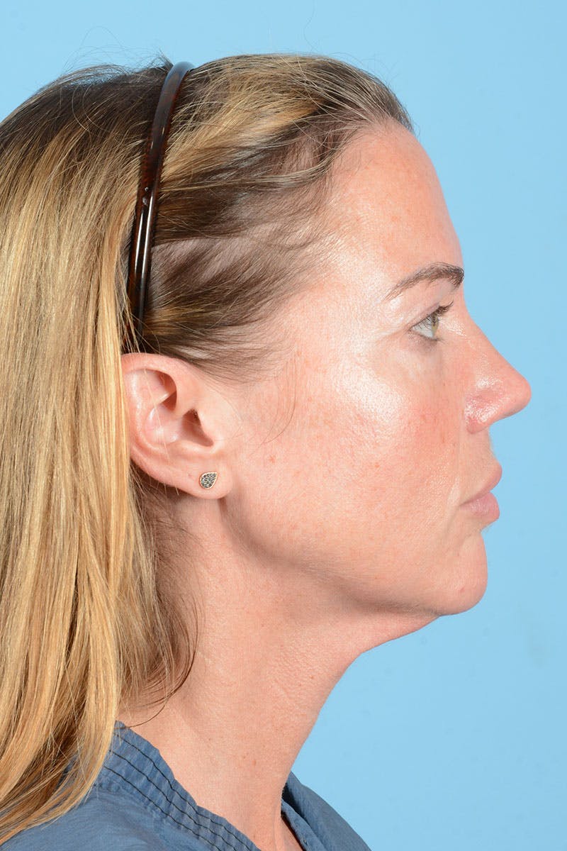 Facial Augmentation Before & After Gallery - Patient 238488 - Image 7