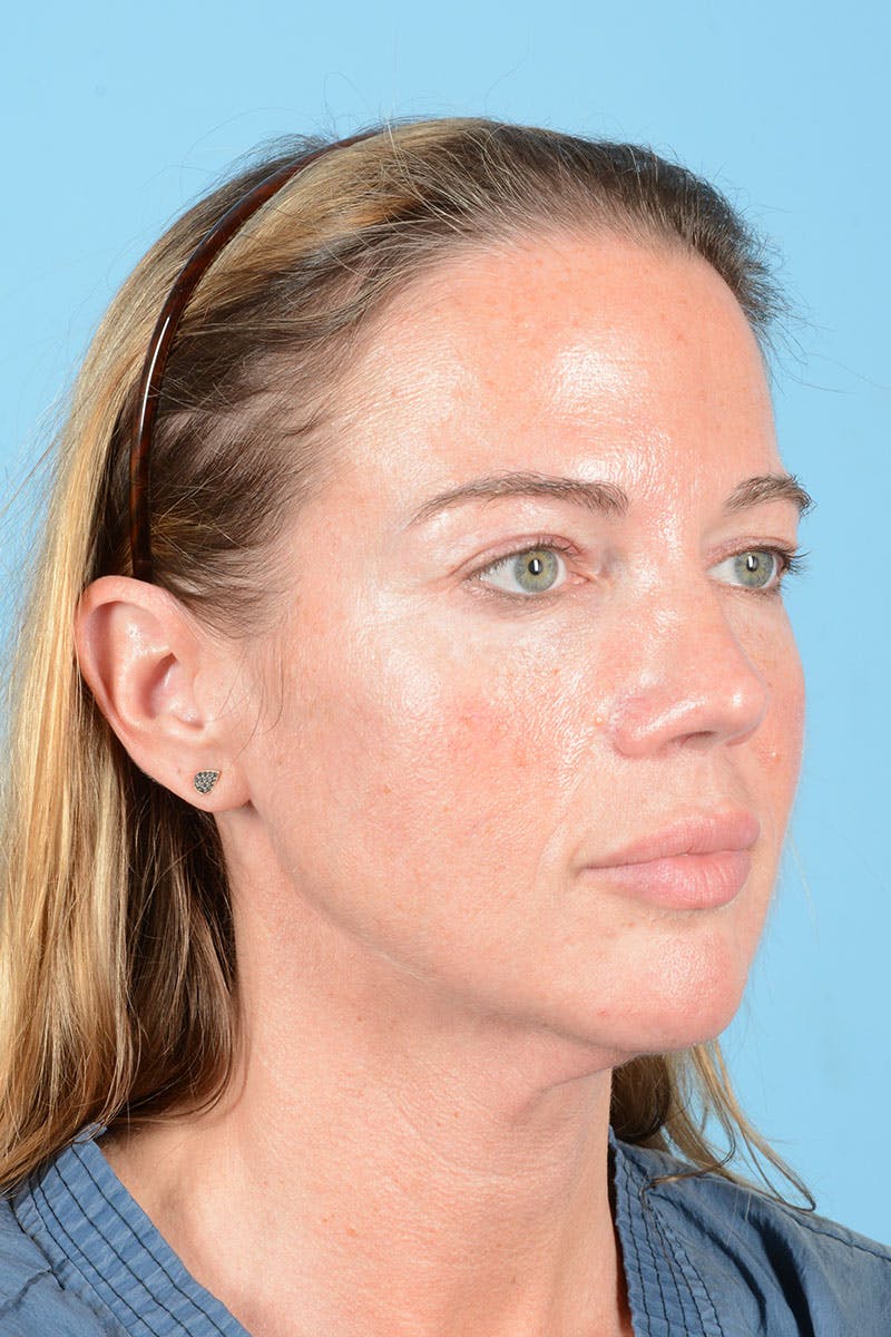 Facial Augmentation Before & After Gallery - Patient 238488 - Image 9