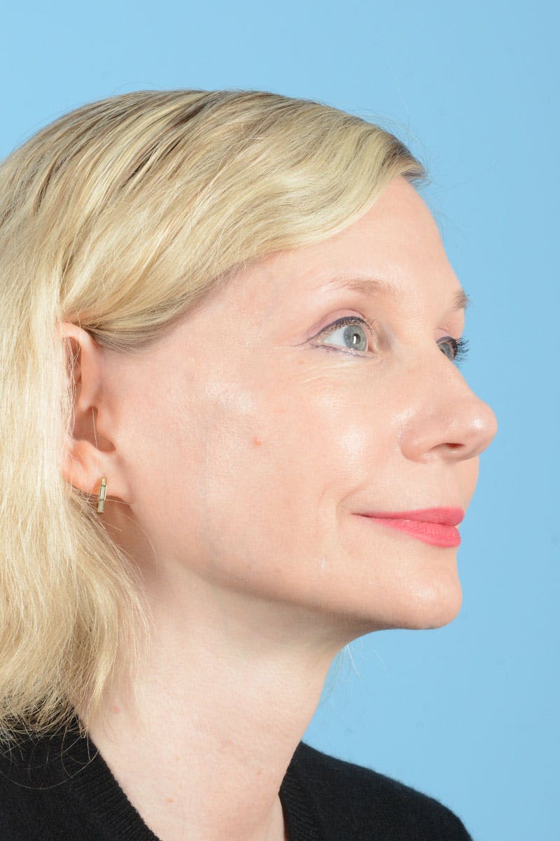 Facelift Before & After Gallery - Patient 235836 - Image 12