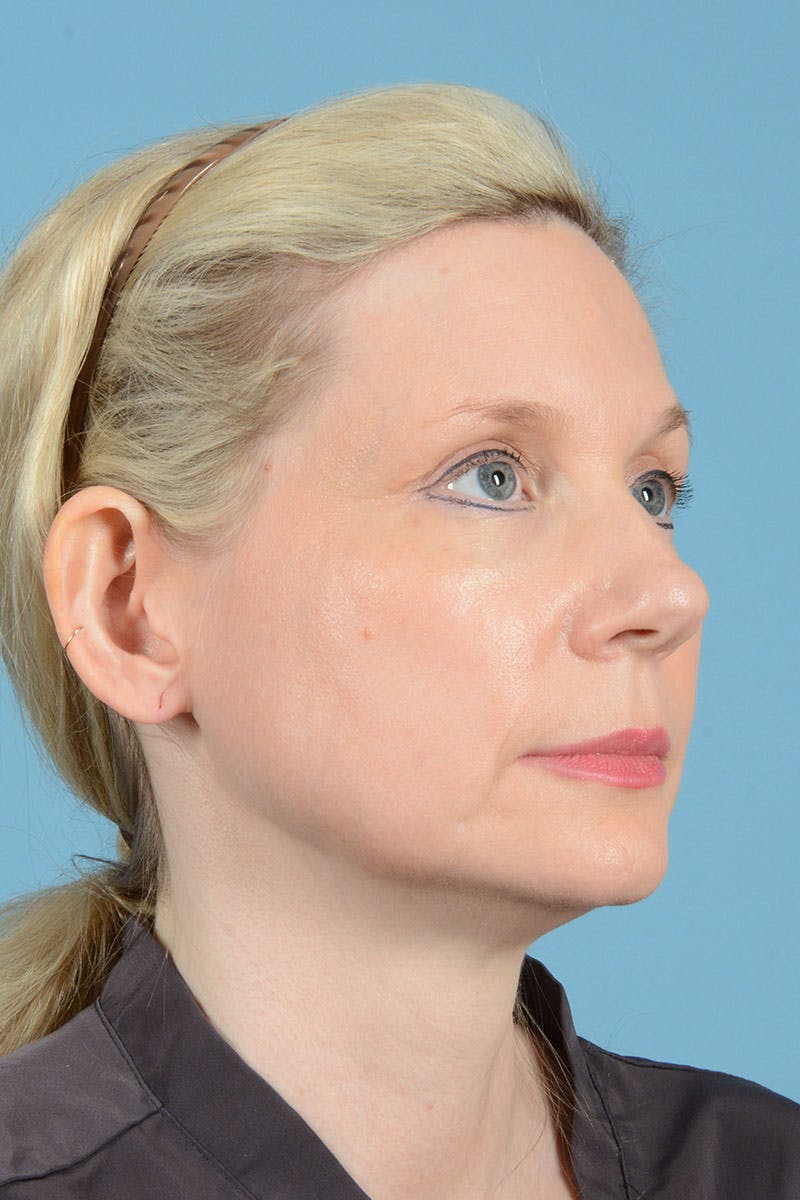 Facelift Before & After Gallery - Patient 235836 - Image 11