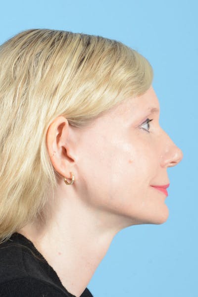 Facelift Before & After Gallery - Patient 235836 - Image 10