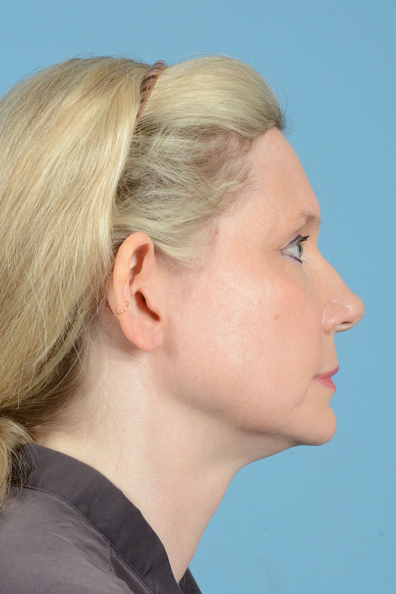 Facelift Before & After Gallery - Patient 235836 - Image 9