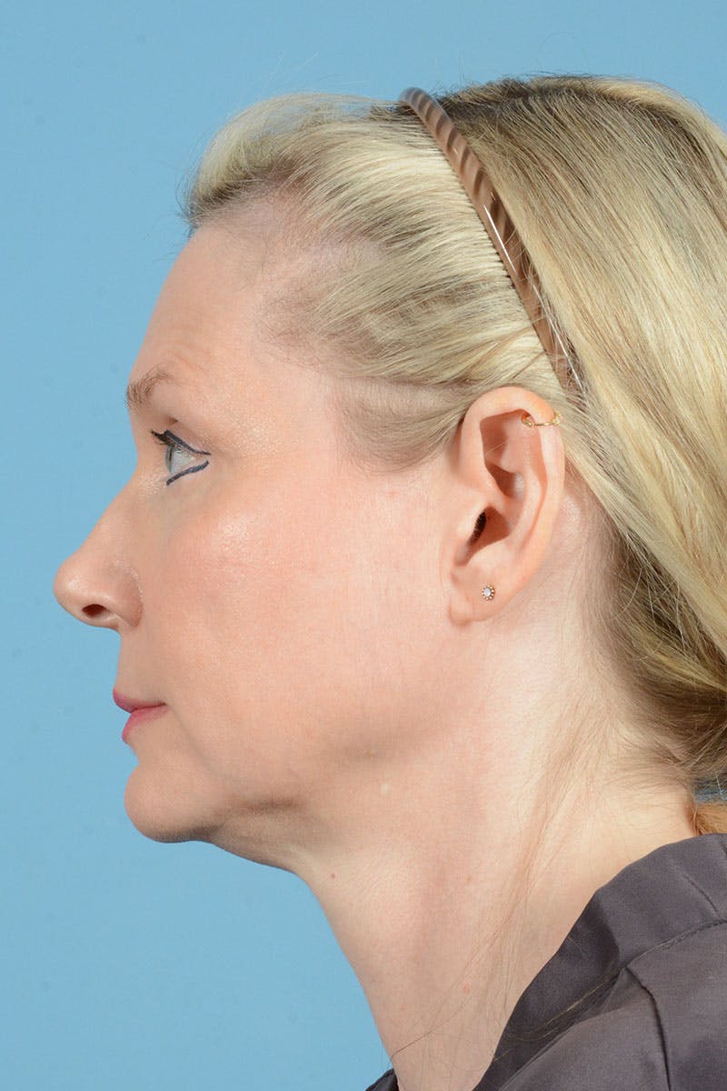 Facelift Before & After Gallery - Patient 235836 - Image 7