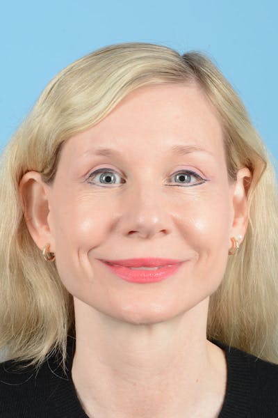 Facelift Before & After Gallery - Patient 235836 - Image 4