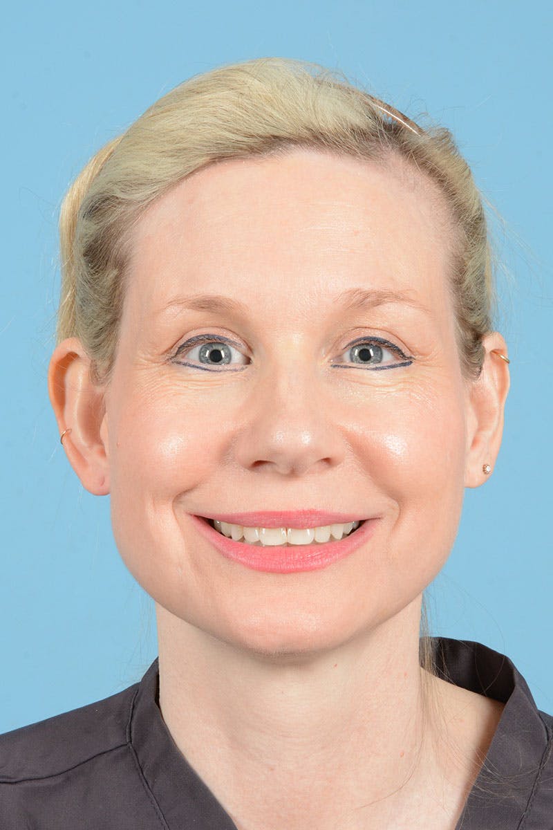 Facelift Before & After Gallery - Patient 235836 - Image 3