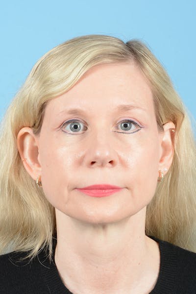 Facelift Before & After Gallery - Patient 235836 - Image 2
